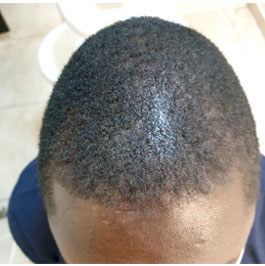 After-Hair Transplant 2